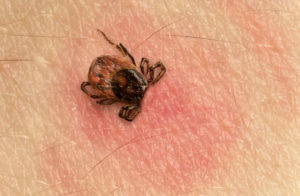 Lyme Disease and Autism Conditions on rise