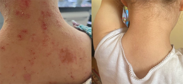 severe eczema